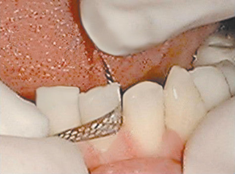 FLEXVIEW IPR INTERPROXIMAL STRIPS (PK10)