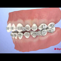 CS5 SYSTEM FOR CLASS II & III (PIVOT TWIST LOCK)