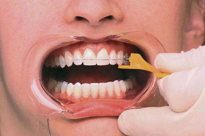 ZAND Orthodontic Gauge