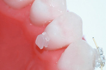 Tooth Color Button TOOTH COLOURED LINGUAL BUTTON (PK10) – Main Orthodontics
